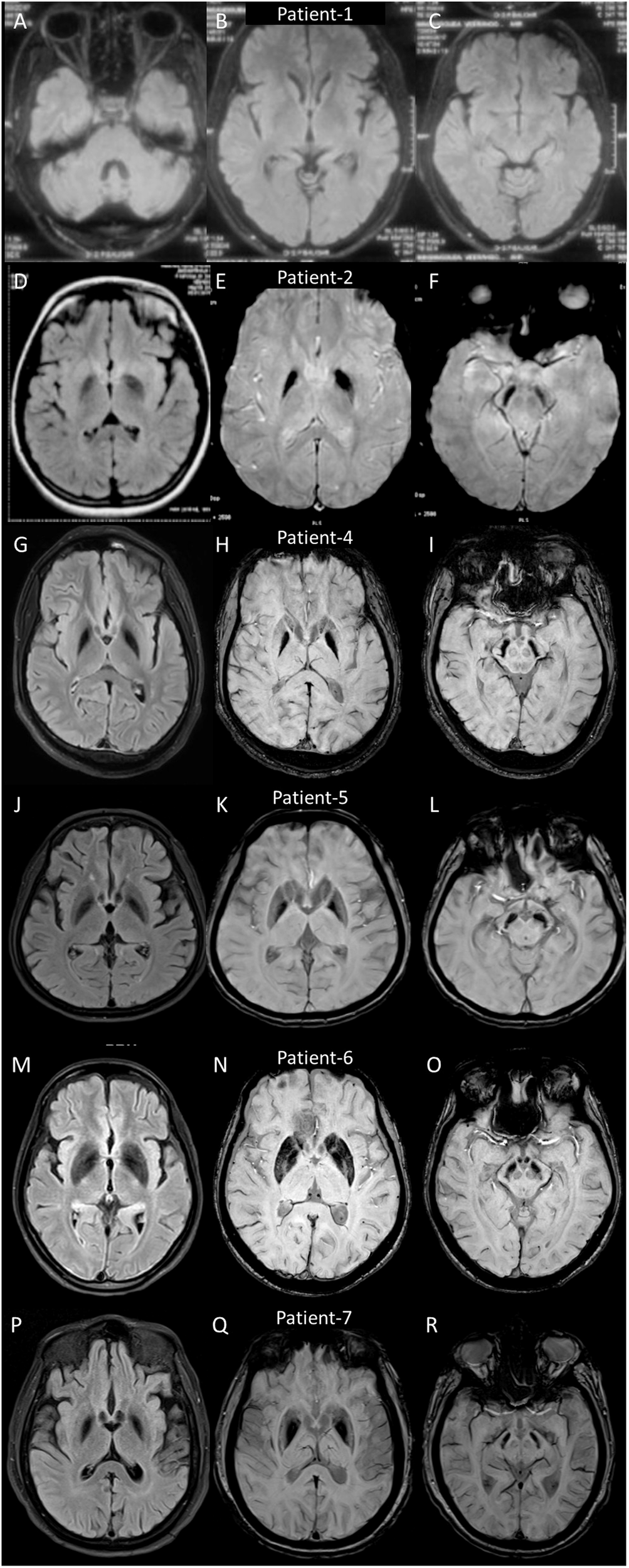 ejhg_journal's tweet card. European Journal of Human Genetics - C19orf12 gene variants causing mitochondrial membrane protein-associated neurodegeneration (MPAN)