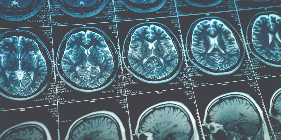 GreggDCaruso's tweet card. Neuroscientists have found that people with aphantasia show distinct patterns of brain activity during imagery tasks, even without subjective visual experience. The study suggests that mental imagery...
