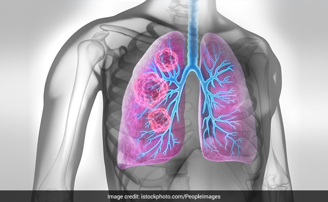 peush_me's tweet card. World Lung Cancer Day is observed on August 1. Smoking is one of the major modifiable risk factors that can increase the risk of lung cancer. Here's all you need to know.