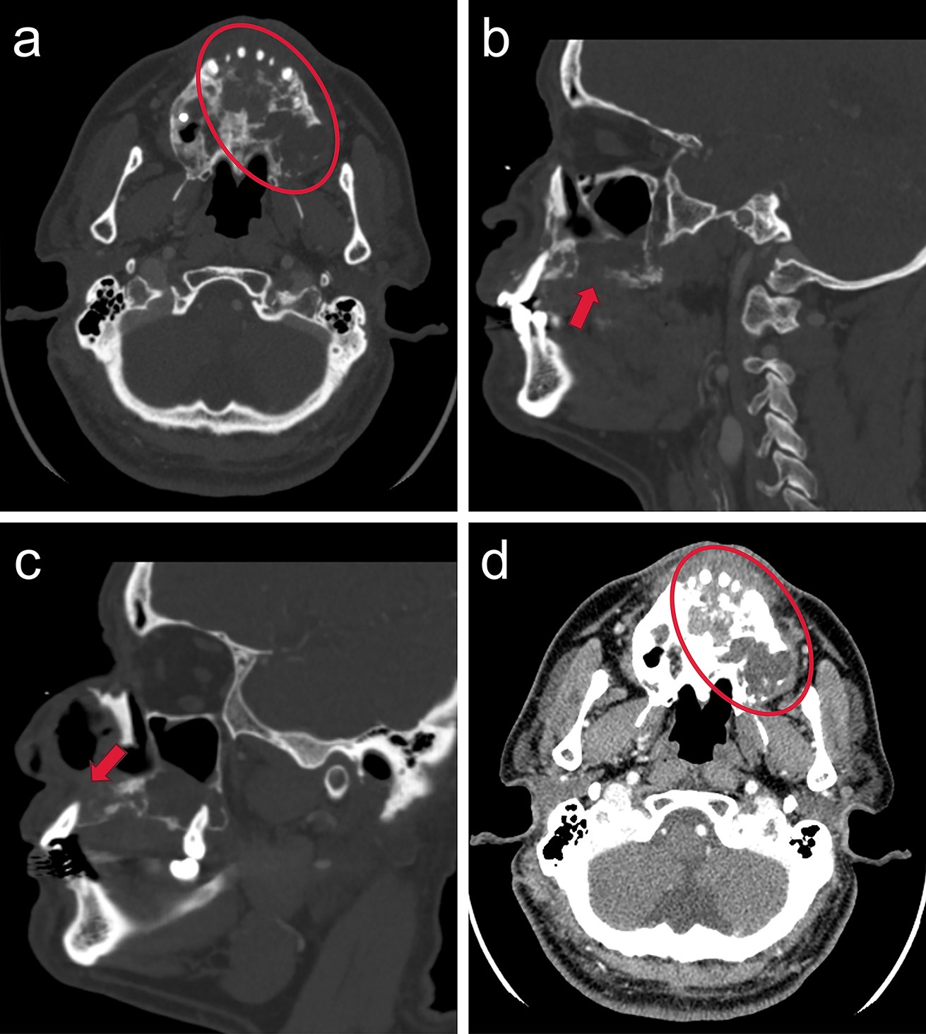 SpringerPath's tweet card. Head and Neck Pathology - CDK4/MDM2 co-amplification, a molecular aberration predominantly observed in sarcomas, has not been previously reported in odontogenic neoplasms. We present the first...