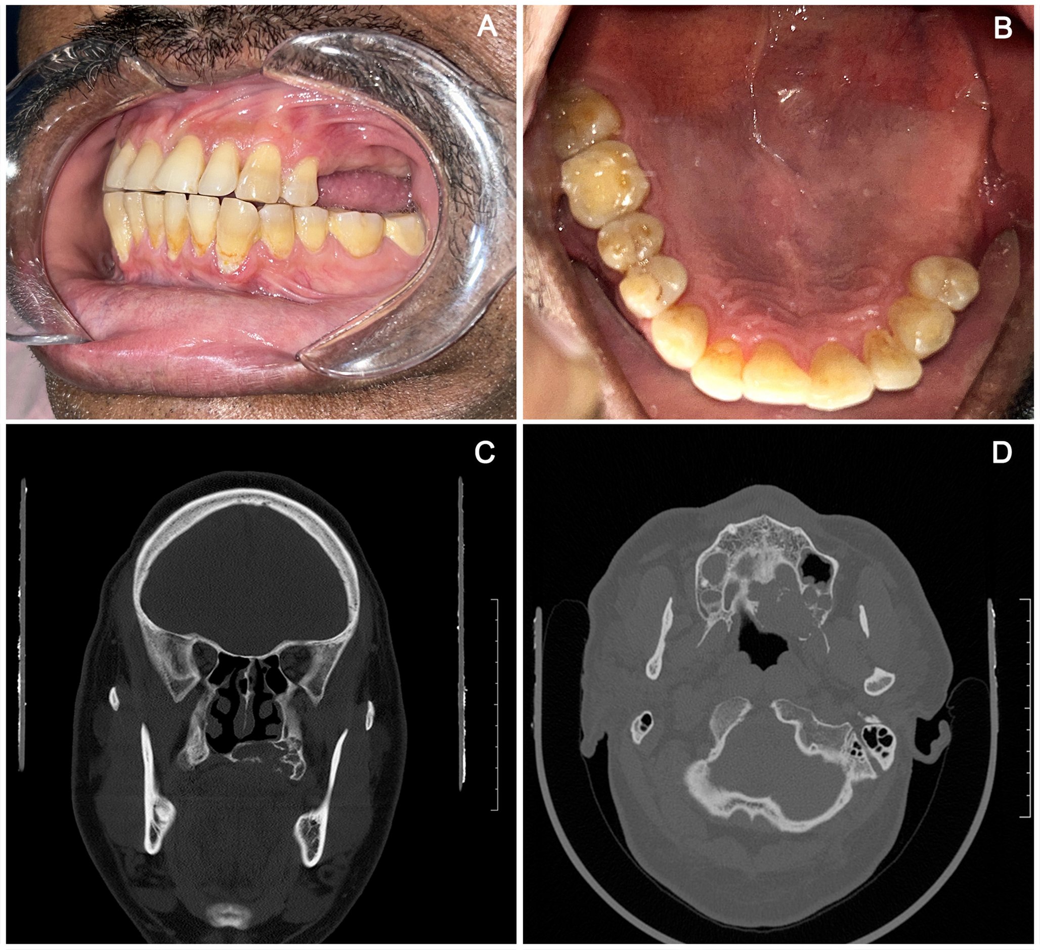 SpringerPath's tweet card. Head and Neck Pathology - Mucoepidermoid carcinoma (MEC) is the most common malignant neoplasm of salivary gland origin, accounting for approximately 27% of all salivary gland malignancies. While...