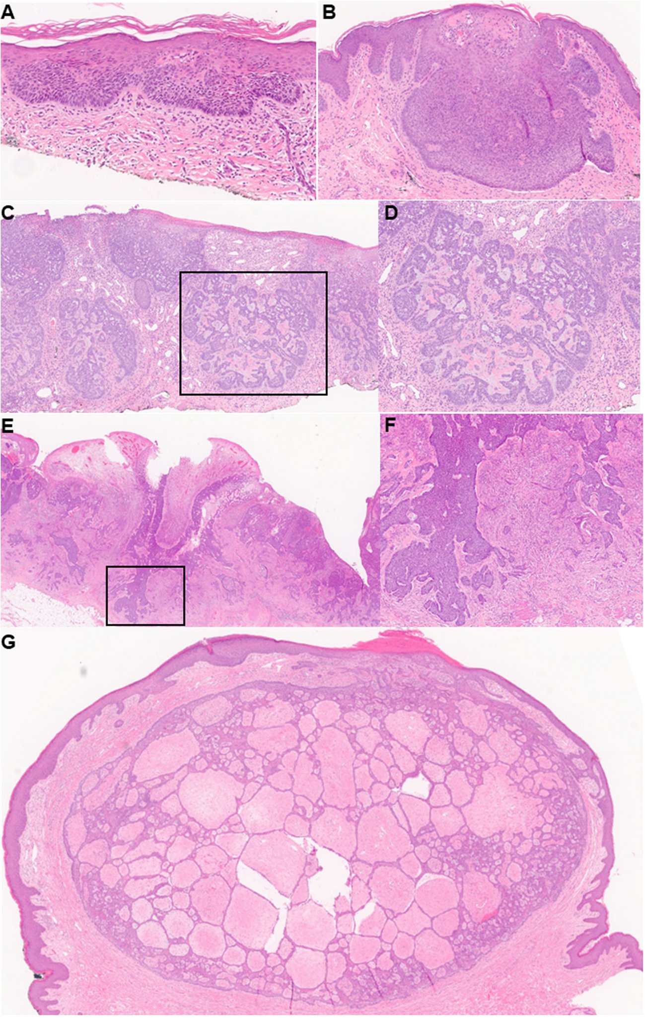 SpringerPath's tweet card. Virchows Archiv - Basal cell carcinoma (BCC) is a frequently diagnosed cancer often associated with increased cumulative sun exposure. BCCs rarely occur on sun-protected areas, such as the external...