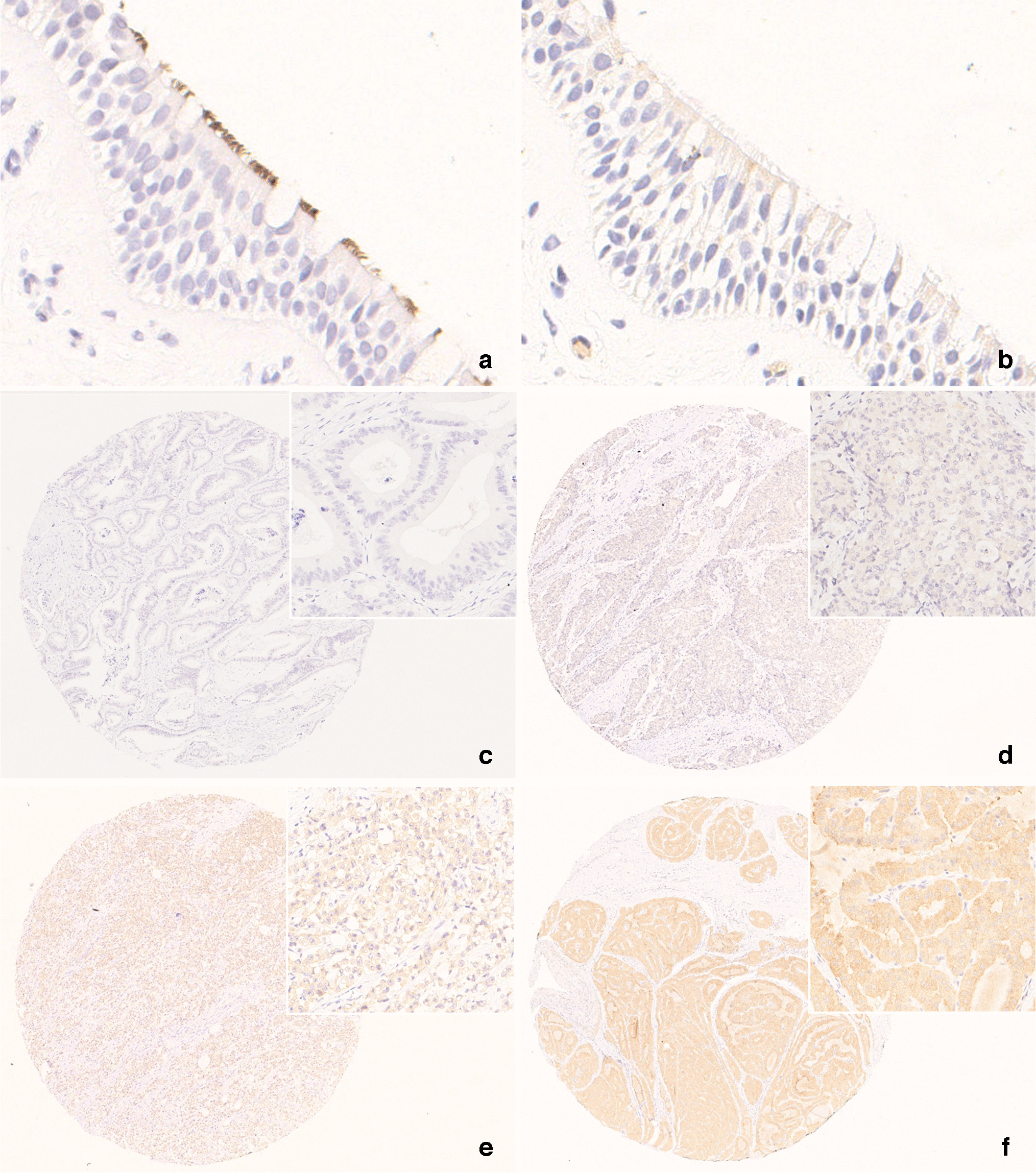 SpringerPath's tweet card. Virchows Archiv - BRAF immunohistochemistry (IHC) serves as a surrogate for BRAF p.V600E but shows variable performance across tumor types and institutions. This study evaluated BRAF IHC staining...