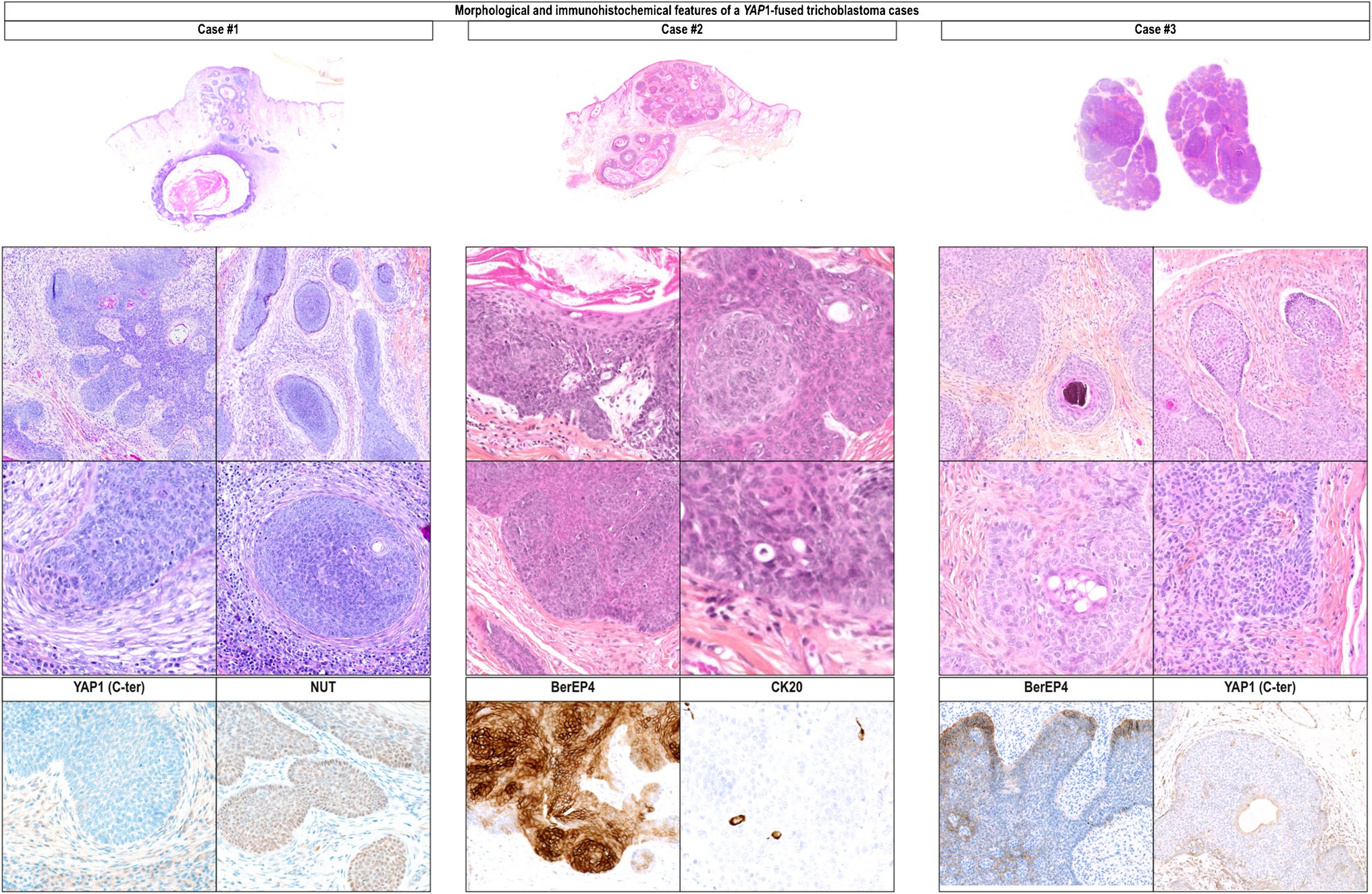 SpringerPath's tweet card. Virchows Archiv - In 2019, YAP1::MAML2 and YAP1::NUTM1 rearrangements were demonstrated in the majority of poromas and in porocarcinomas. Recently, our group demonstrated recurrent fusions of PAK...