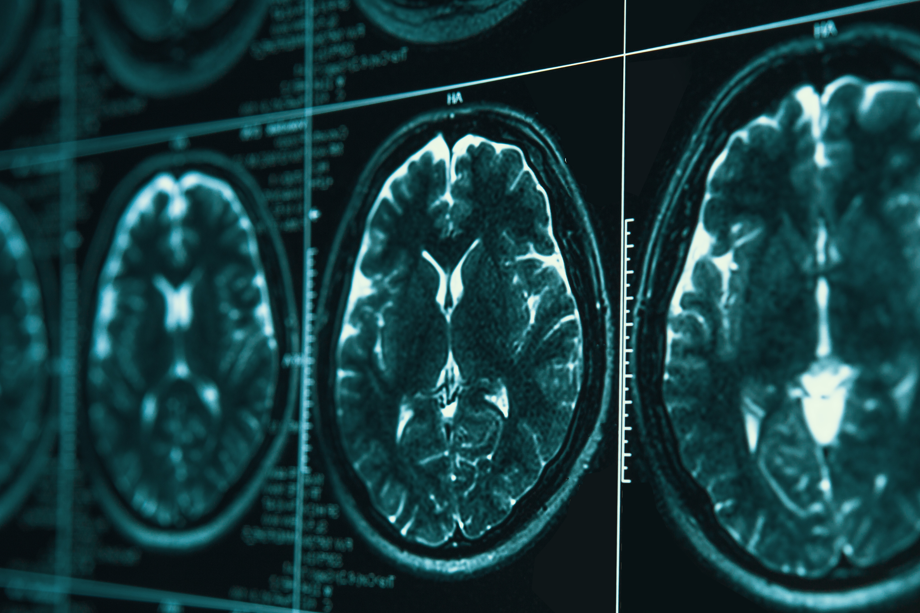 MedLinkNeurol's tweet card. Fluid dynamics model could help hydrocephalus patients