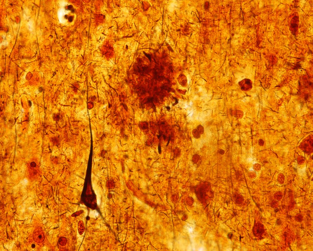GrinsteinJ's tweet card. The durable treatment of several mutations for a neurodevelopmental disorder in vivo has implications for developing personalized gene-editing drugs.