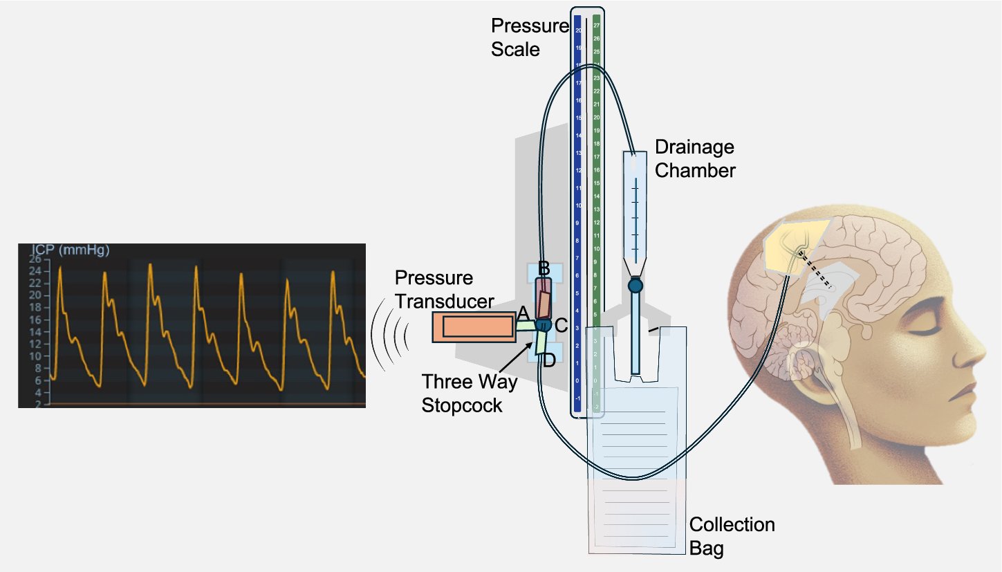 HopkinsNCCU's tweet card. npj Digital Medicine - Classification of intracranial pressure epochs using a novel machine learning framework