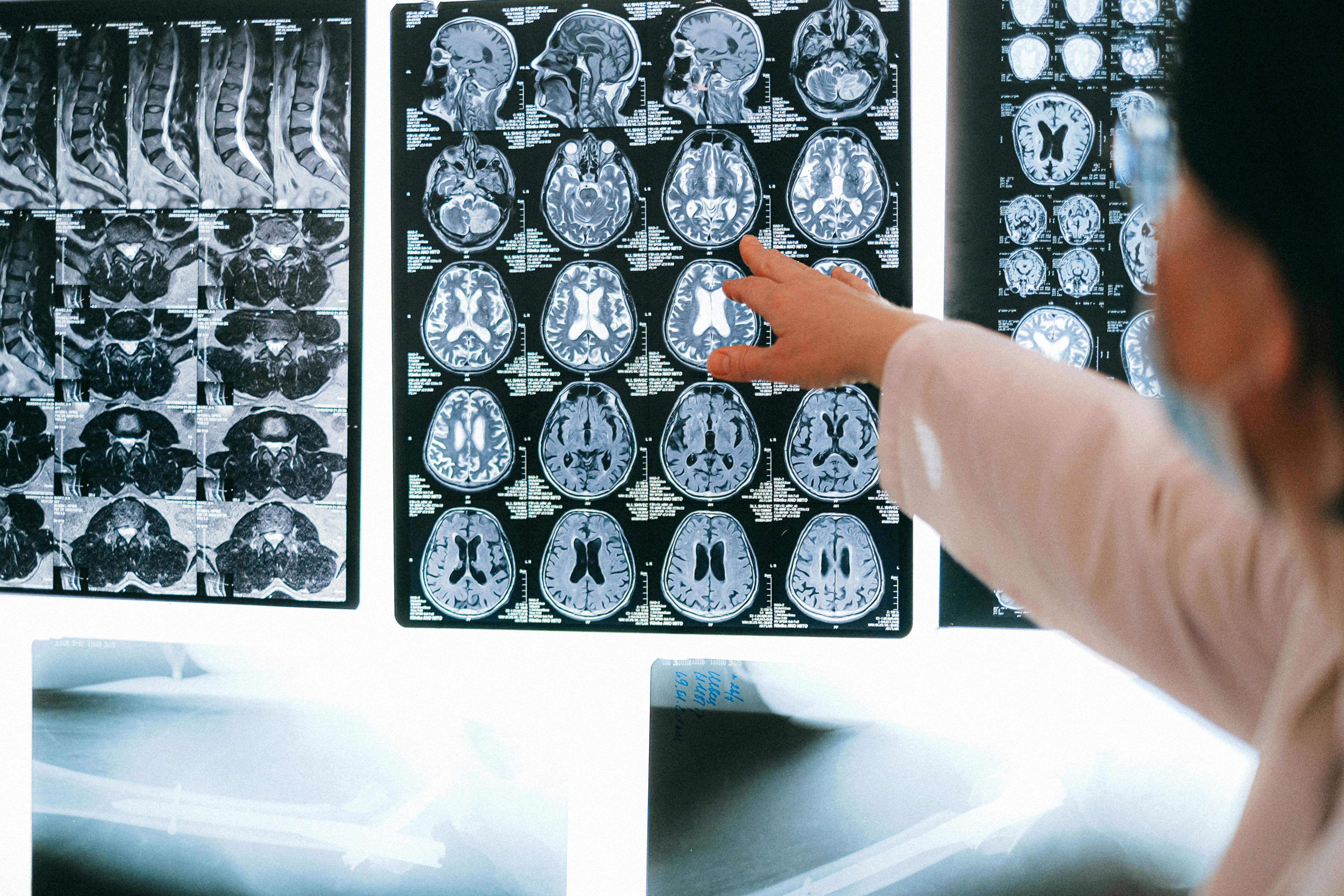WashUAlumni's tweet card. A WashU anthropologist joins a study uncovering the surprising sources — and overlooked sufferers — of an increasingly common disease.