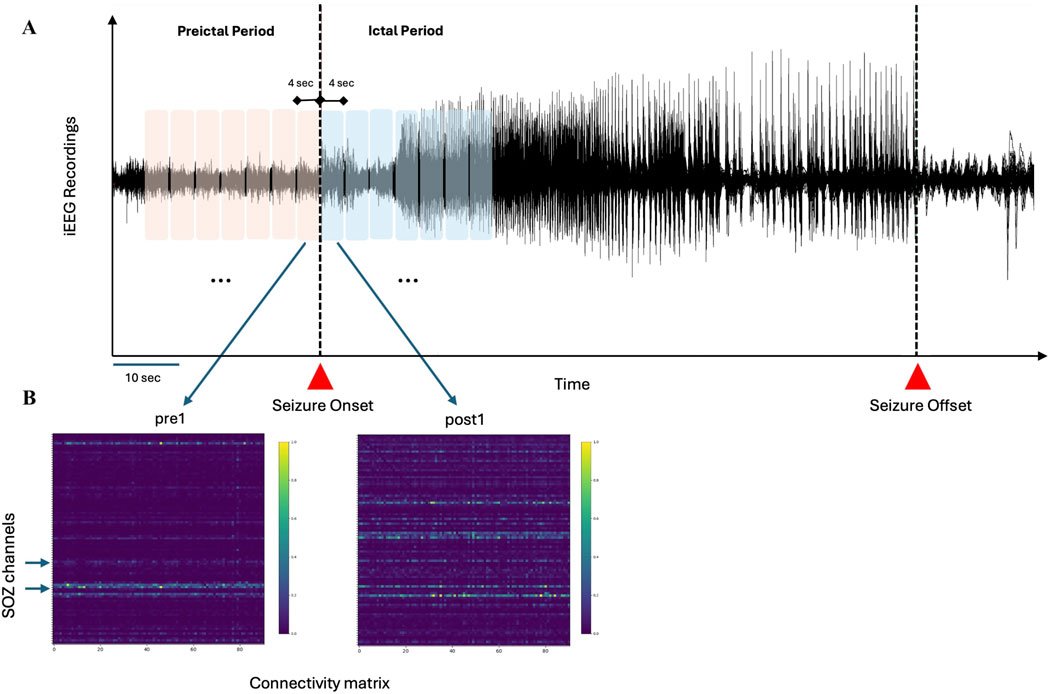 FrontNetPhysiol's tweet card. Introduction:Focal resective surgery can be an effective treatment option for patients with refractory epilepsy if the seizure onset zone is accurately ident...