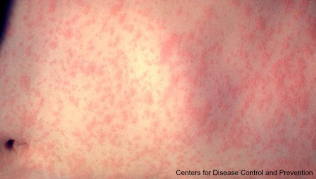 WOODTV's tweet card. Kent County says it has recorded two more measles cases for a total of four this year.