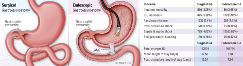 rcverdonk's tweet card. Malignant gastric outlet obstruction (MGOO) is an unfortunate adverse event of advanced upper GI malignancies. Historically, surgical gastrojejunostomy (SGJ) has been the procedure of choice to...