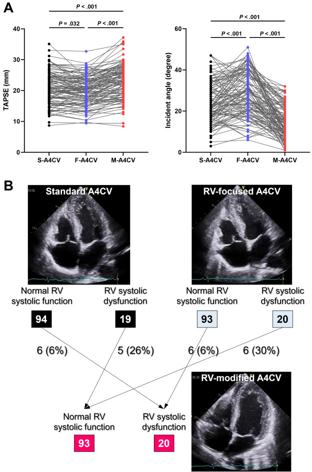 NabilNaser11's tweet card. Right ventricular (RV) systolic function assessment is crucial in cardiovascular diseases.1 Tricuspid annular plane systolic excursion (TAPSE) is the most widely used quantitative parameter; however,...