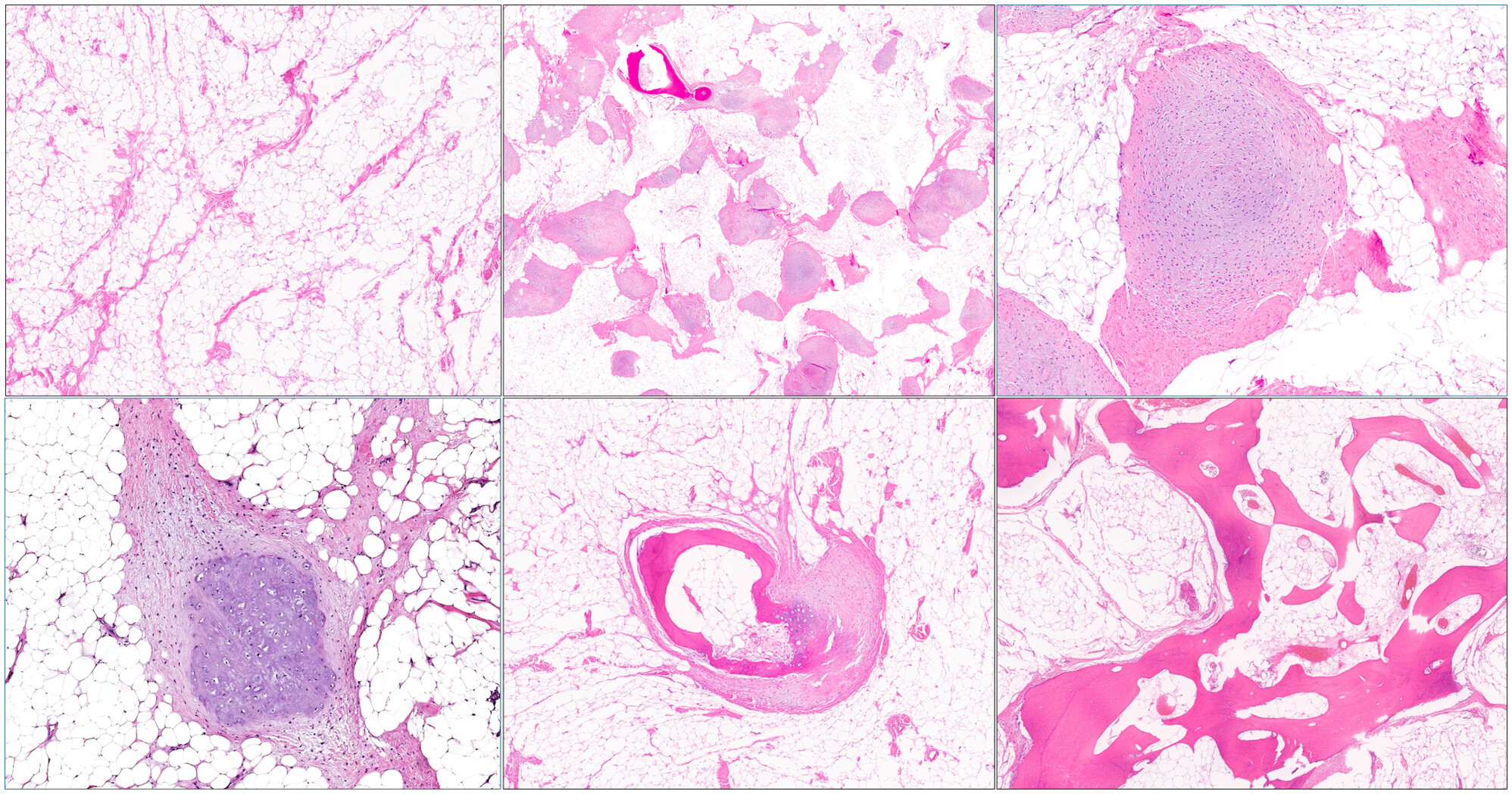 Histo_Journal's tweet card. In this study, we provide a comprehensive analysis of 18 osteolipomas, including a detailed morphological assessment and molecular characterization of a subset of cases. Our findings strengthen the...