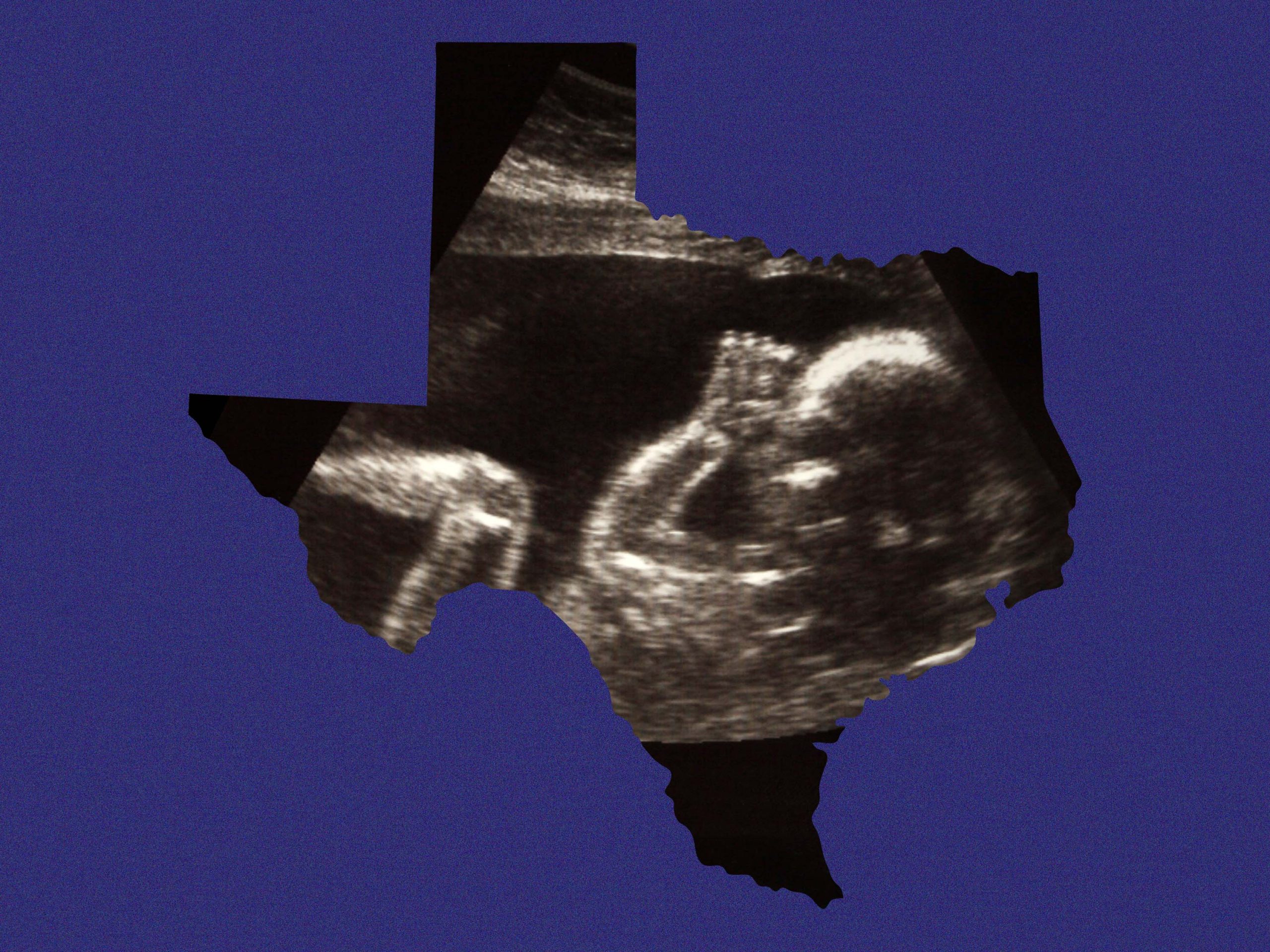 CaraReports's tweet card. Texas doctors say here’s how to navigate pregnancy, miscarriage, complications, and what to consider if you need life-saving abortion care.