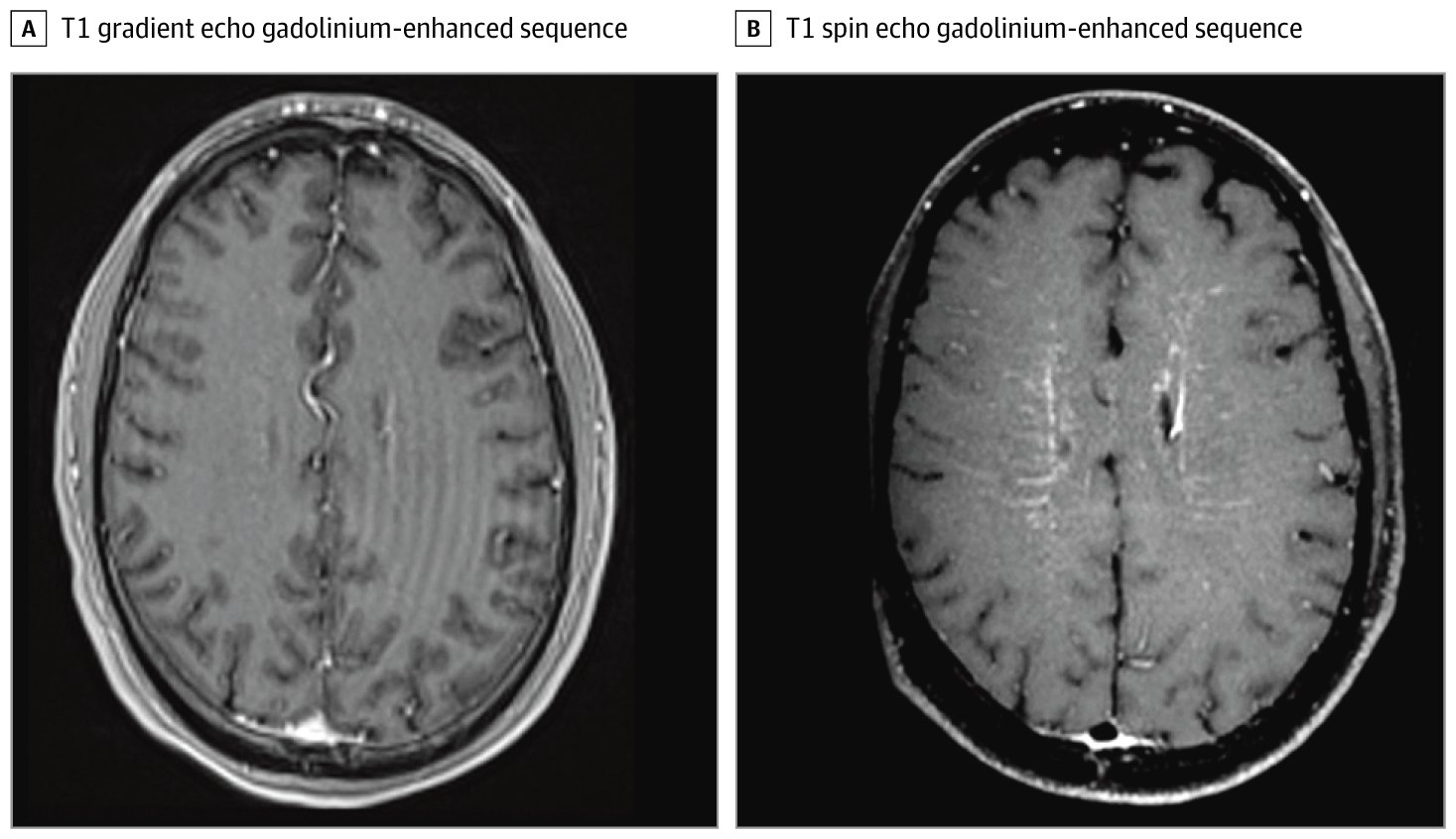 AMAEdHub's tweet card. This case report highlights brain imaging of 2 patients with a disease course suggestive of autoimmune glial fibrillary acidic protein astrocytopathy.