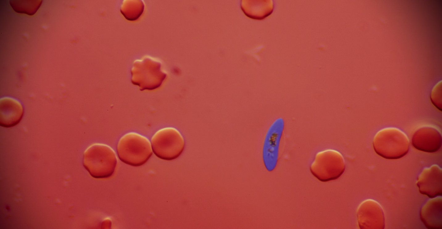 NatureMicrobiol's tweet card. Nature Microbiology - Fitsum Tadesse was infected with malaria as a young child in Ethiopia and faced challenges to access efficacious treatment during a time of widespread drug resistance. Today,...