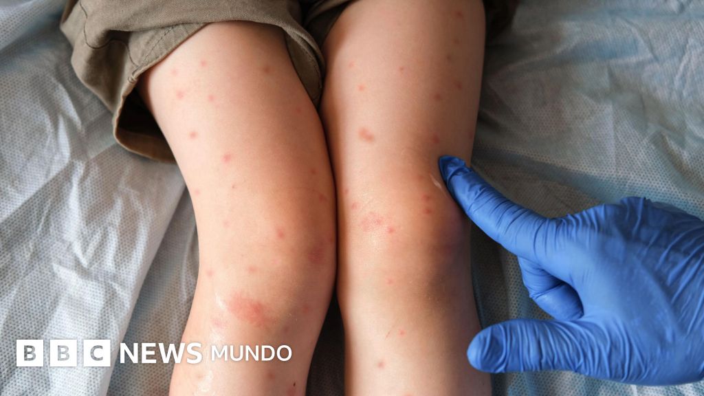 bbcmundo's tweet card. Los casos confirmados de sarampión en el país son casi tres veces superiores a los de su vecino del sur, Estados Unidos, a pesar de que su población es mucho menor.