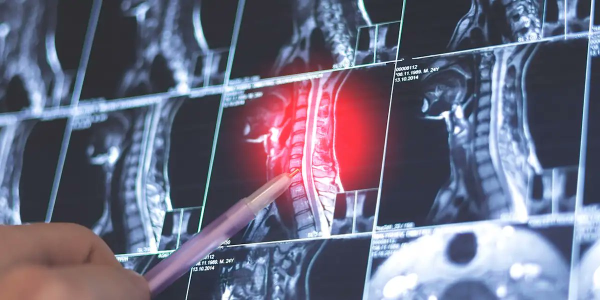 OncNewsCentral's tweet card. Adding perioperative pembrolizumab to standard of care significantly improves event-free survival in locally advanced head and neck squamous cell cancers.