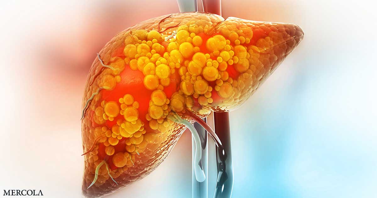 mercola's tweet card. Fatty liver disease is a strong indicator that your metabolism is in trouble, and research shows that krill oil can mitigate it.