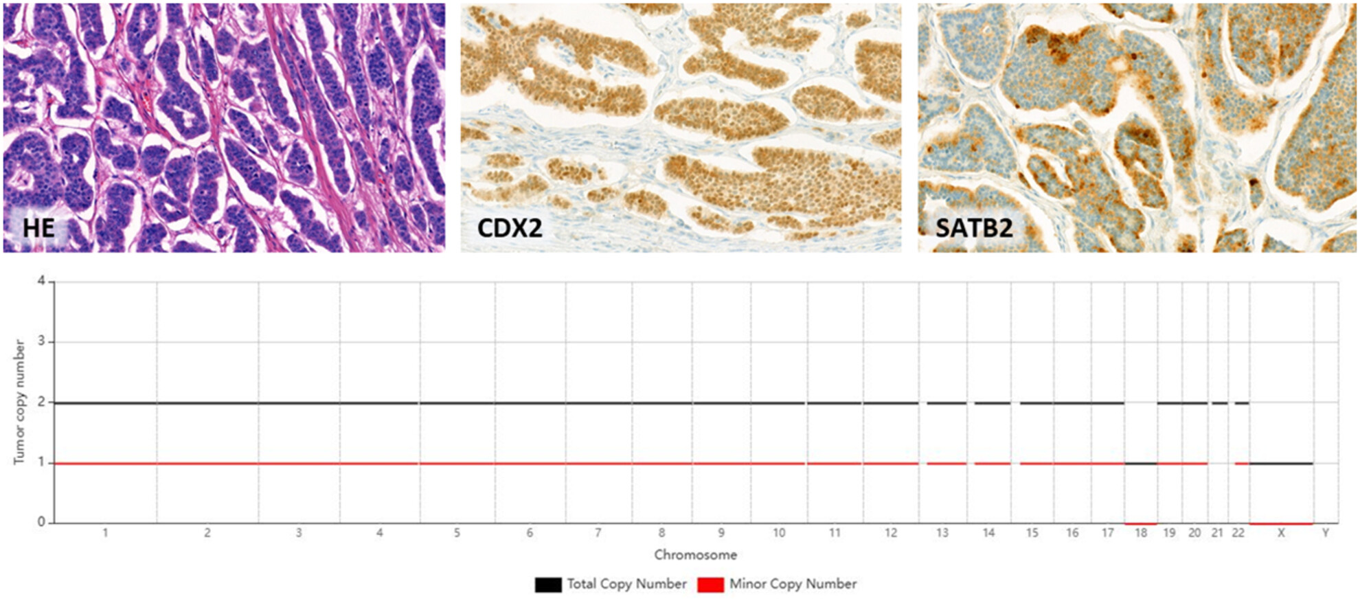 Histo_Journal's tweet card. In this study, we assessed five cases of prepubertal-type testicular neuroendocrine tumours. On immunohistochemistry, we observed varying levels of positivity with CDX2 and SATB2 antibodies. Compre...
