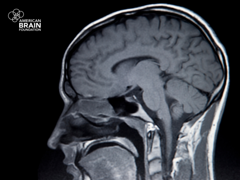 ABFbrain's tweet card. Is stroke connected to other conditions? Explore the links to heart disease, infections, migraine, and more.