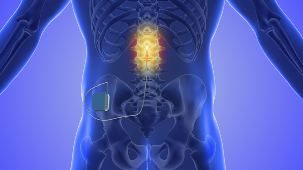CGMMaher's tweet card. The Australian Government should ban the use of spinal cord stimulators for pain after research reveals one-in-three people are having revision surgery for complications that can end up costing...
