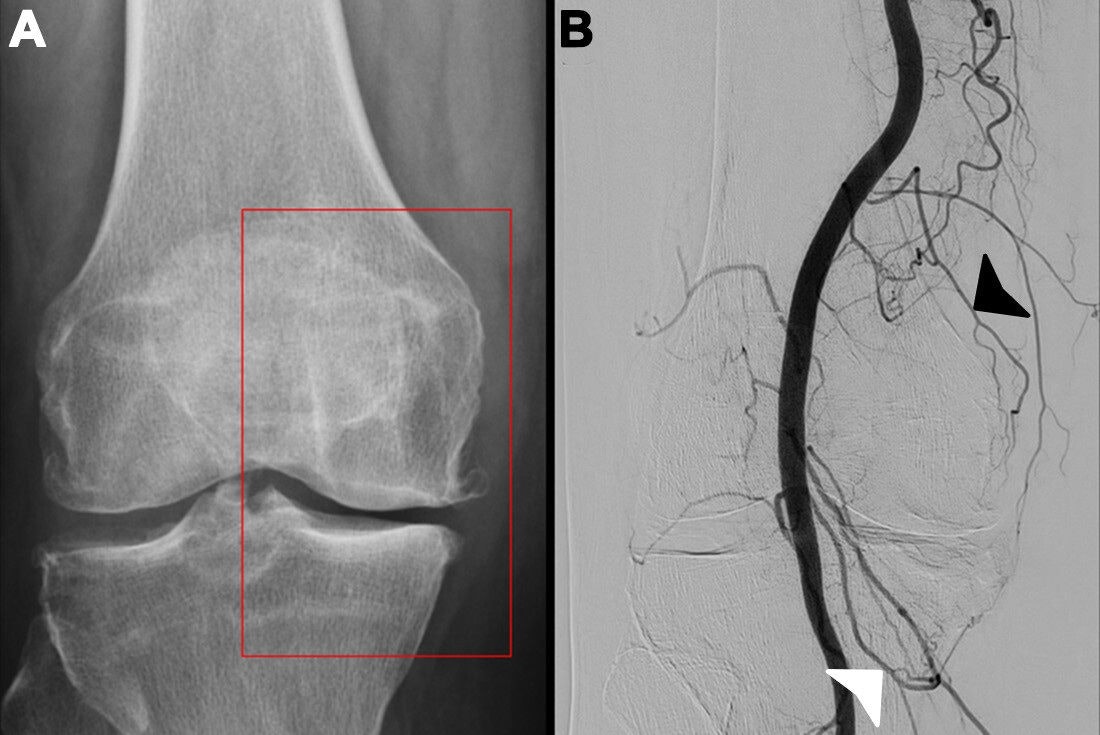 AuntMinnie's tweet card. Genicular artery embolization (GAE) has proven safe and effective in patients with pain and disability due to knee osteoarthritis.