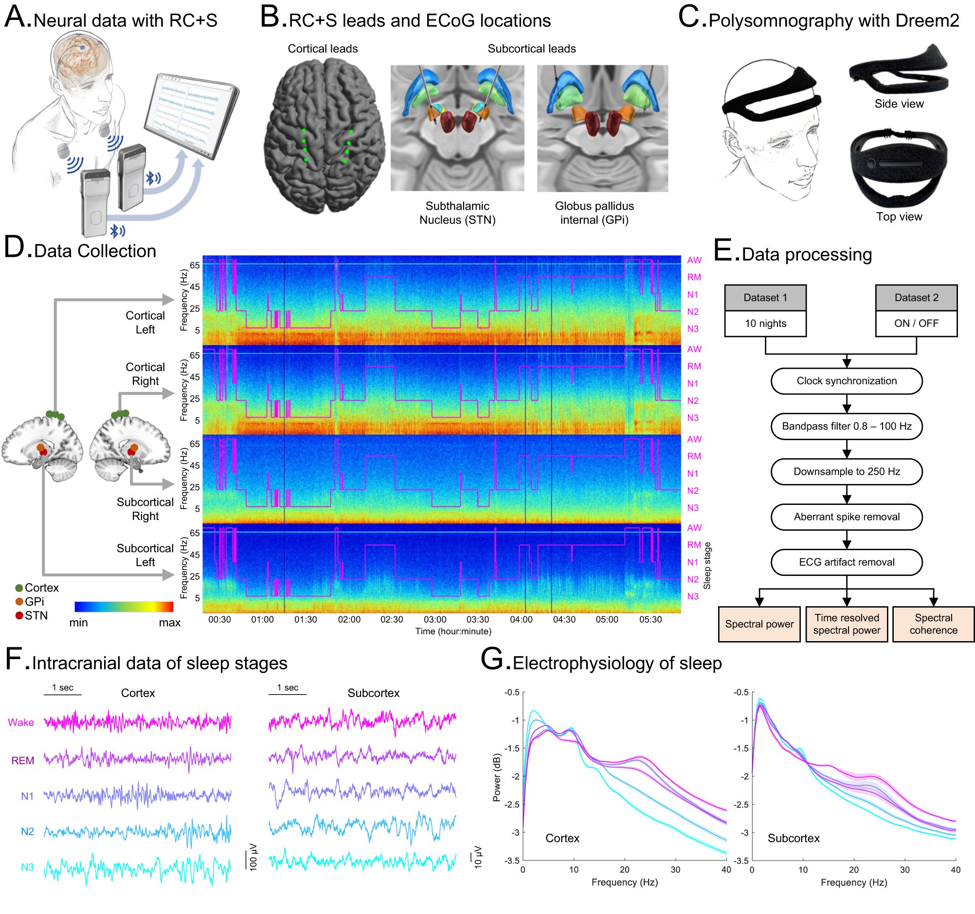 littleneuro's tweet card. Nature Communications - Using at-home intracranial DBS recordings in PD participants, the authors found subcortical beta has an inverse effect on cortical slow-wave in NREM sleep, rises before...
