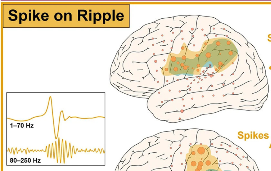 CureEpilepsy's tweet card. In a large cohort of children with drug-resistant epilepsy, researchers showed that "fast ripples" are the best biomarkers to predict surgical outcomes, but they can be seen in only 43% of patients.