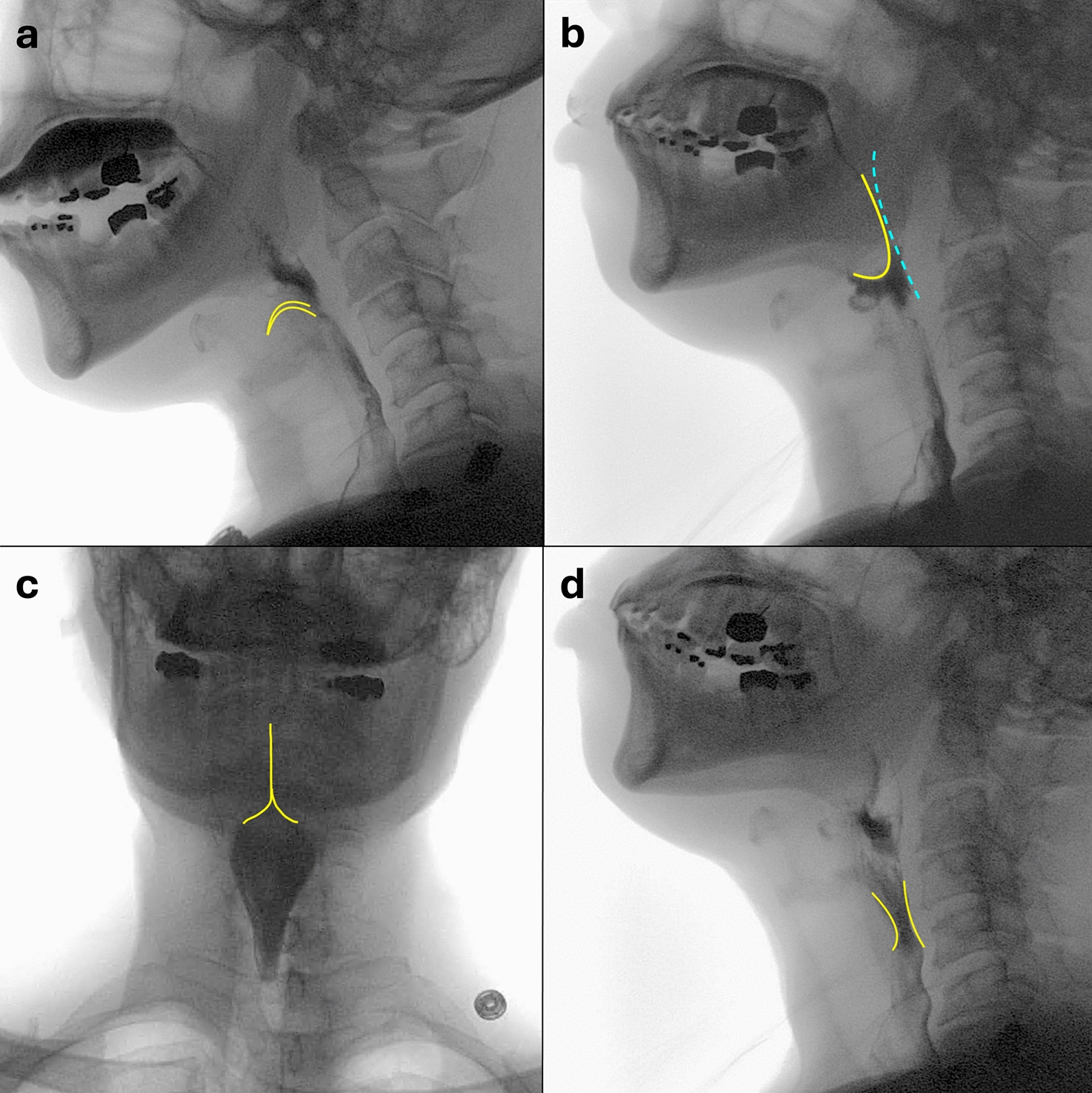 Abdominal_Rad's tweet card. Abdominal Radiology - The modified barium swallow study (MBSS) is a diagnostic examination that visualizes the functional anatomy and physiology of the oral pharyngeal swallowing mechanism in real...