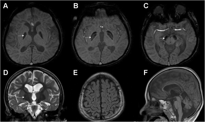 khouryjeanccf's tweet card. We present the case of a 10-year-old Chinese boy with profound developmental delay, spastic quadriparesis, and intractable epilepsy with tonic and atypical absence seizures. He was first noted to...