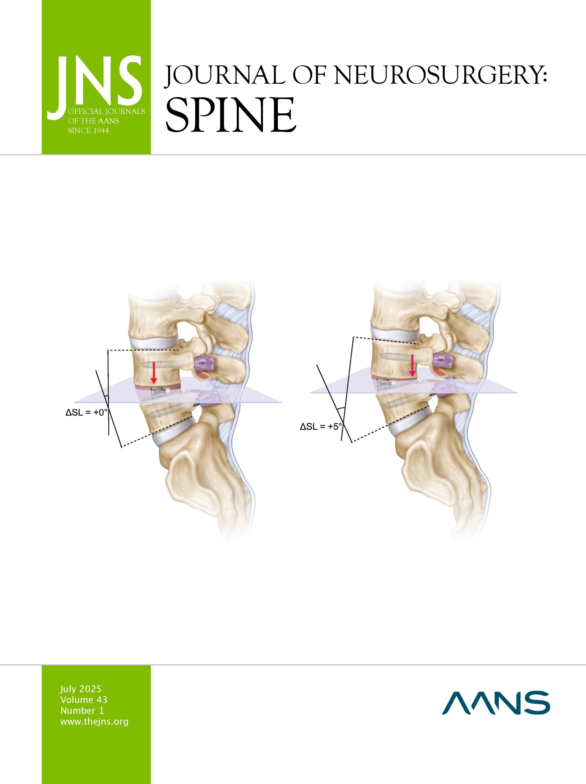 spinesection's tweet card. OBJECTIVE Despite many available surgical techniques, the optimal method to achieve posterior lumbar interbody fusion (PLIF) is unclear. This study compares the efficacy of open transforaminal lumbar...