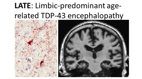 FangChengYeh's tweet card. Nelson et al. describe a recently recognized brain disorder that mimics the clinical features of Alzheimer’s disease: Limbic-predominant Age-related TDP-43