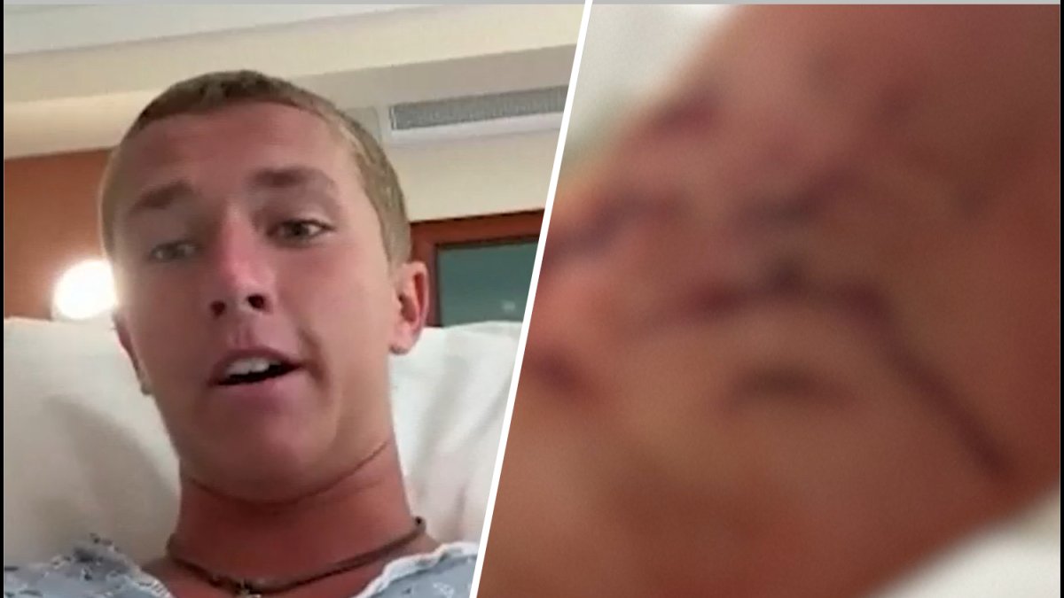 nbcwashington's tweet card. The 18-year-old surf instructor described his shark bite from a hospital bed and said he can't wait to get back in the water.