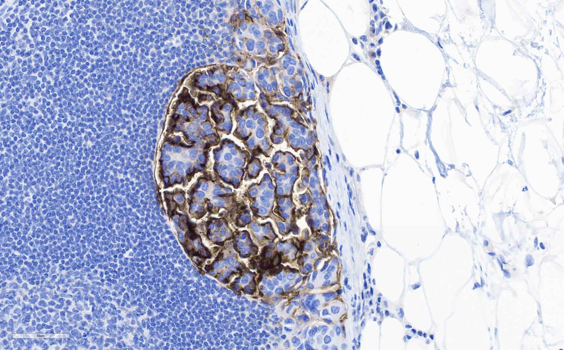 UCSF's tweet card. Scientists found a way to identify and possibly treat a mysterious type of bladder cancer that affects up to 1 in 4 cases.