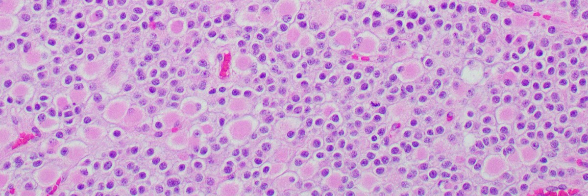 UTHoustonPath's tweet card. UTHealth Neuropathology Fellowship offers training in neoplastic and non-neoplastic neuropathology along with ophthalmologic and neuromuscular pathology.