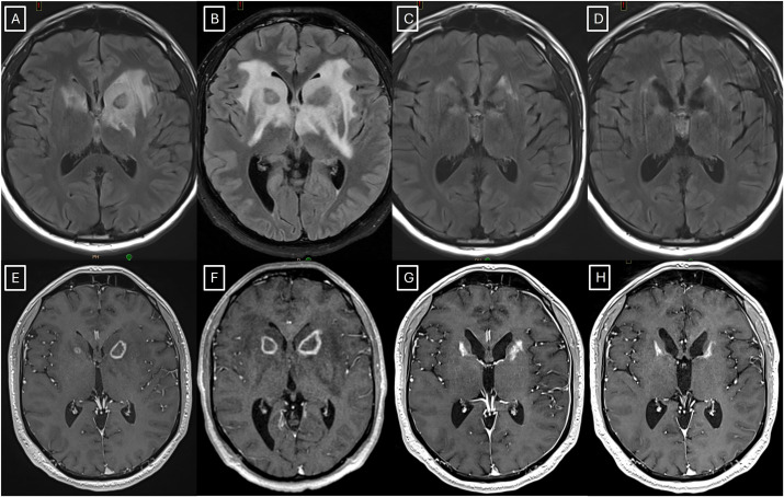 Advances_ASTRO's tweet card. Gamma-Knife based ventral capsulotomy is an established radio-surgical procedure for patients with refractory psychiatric conditions such as obsessive-compulsive disorder (OCD). However, patients can...