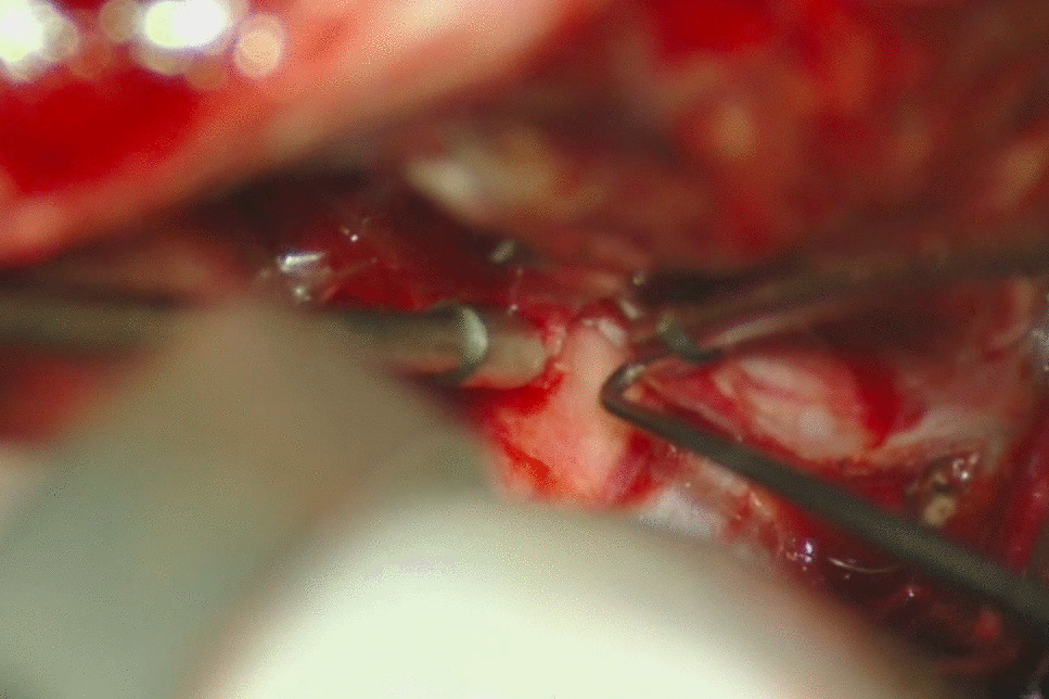 ActaNeuro's tweet card. Acta Neurochirurgica - Paraclinoid aneurysms continue to present a surgical challenge, even in the modern endovascular era. Although these aneurysms are uncommon, surgical clipping remains the...