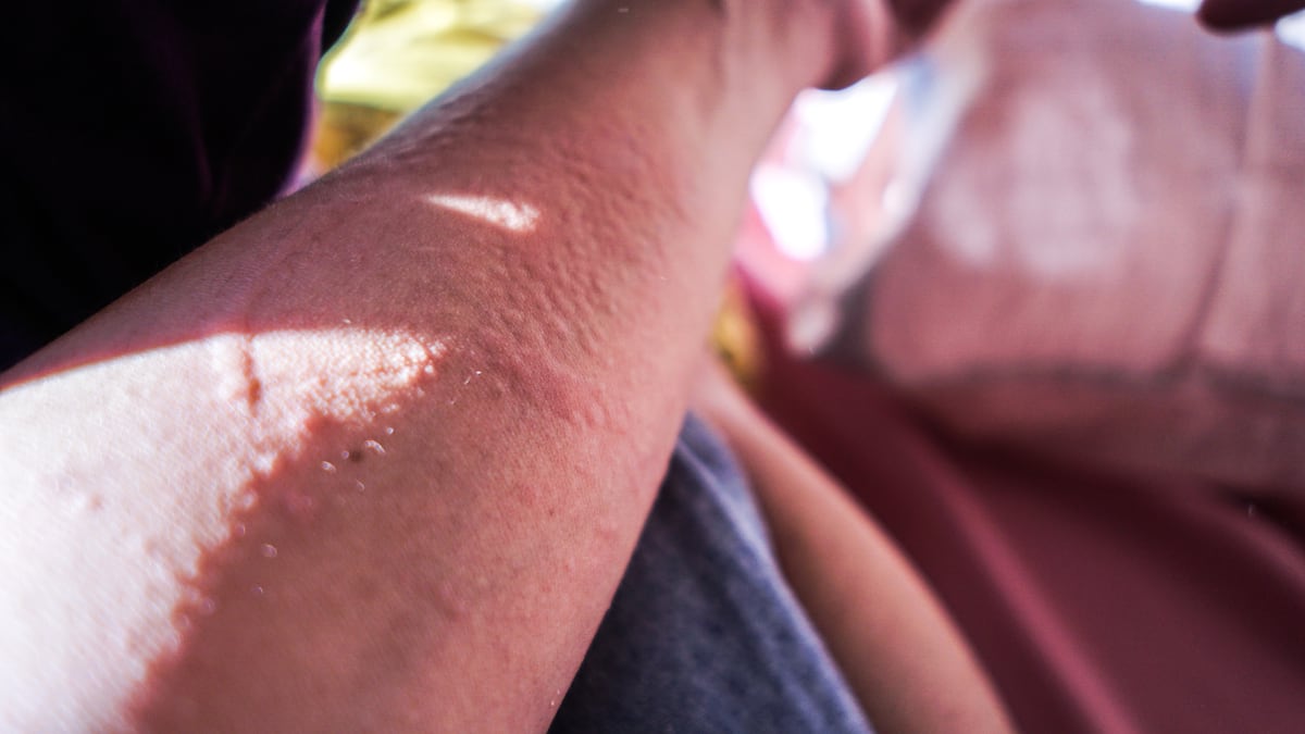 el_pais's tweet card. El sol no es un alérgeno, pero sí puede inducir enfermedades cutáneas como la dermatitis fotoalérgica y la urticaria solar