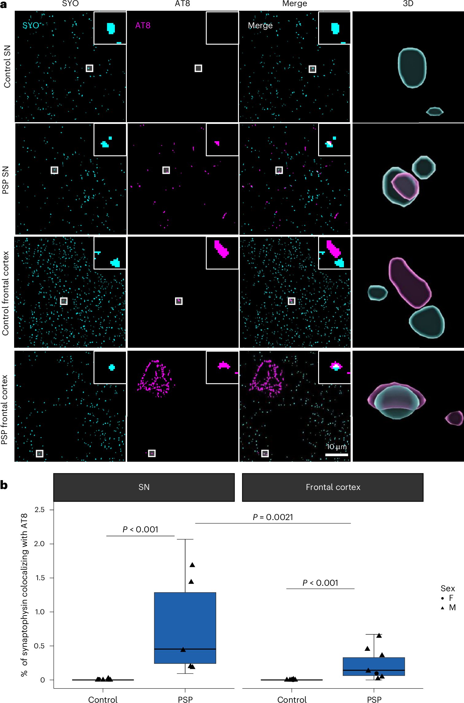 CanAkerman's tweet card. Nature Neuroscience - McGeachan et al. observe oligomeric tau in synapses from individuals with progressive supranuclear palsy and provide evidence that tau pathology may spread through the brain...