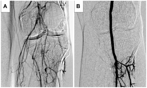 JVascSurgCIT's tweet card. Endovascular management in patients with failed lower extremity bypasses can be beneficial; however, current treatment options remain limited. The DETOUR system (Endologix), designed for percutaneous...