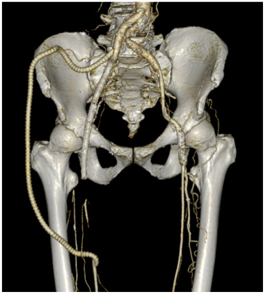 JVascSurgCIT's tweet card. Infections of the groin present significant challenges for both infection control and limb salvage. This case report describes a patient with a history of penile cancer treated with radiation...