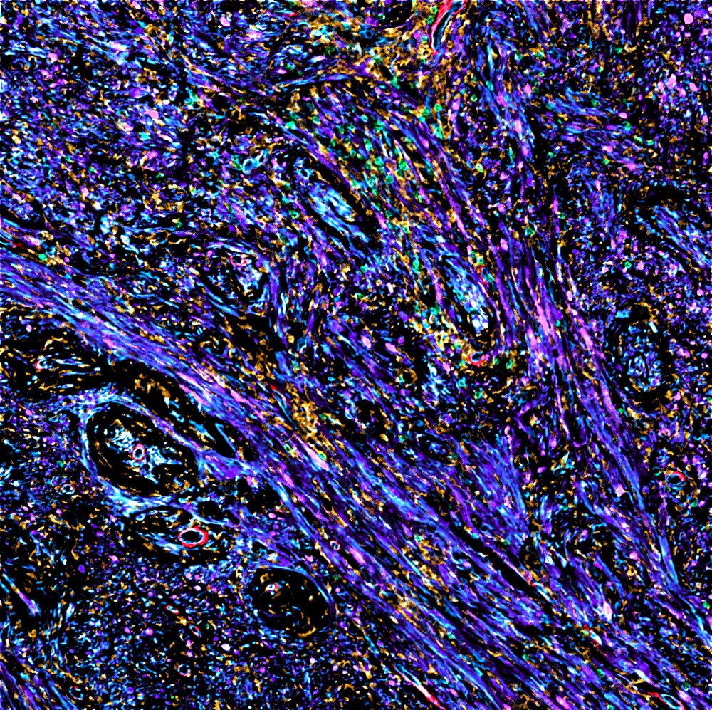 nf2biosolution1's tweet card. Colleagues working across our brain tumour and inflammation themes have been award £700,000 from UK Research and Innovation (UKRI) and The Medical Research Council for their project on Understanding...