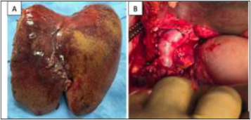 vij_mukul's tweet card. Donor Hepatectomy carries an estimated postoperative mortality of 0.06 to 0.2%1. Though rare, a donor death is a tragedy, primarily for the patient’s family but also for the transplant team.