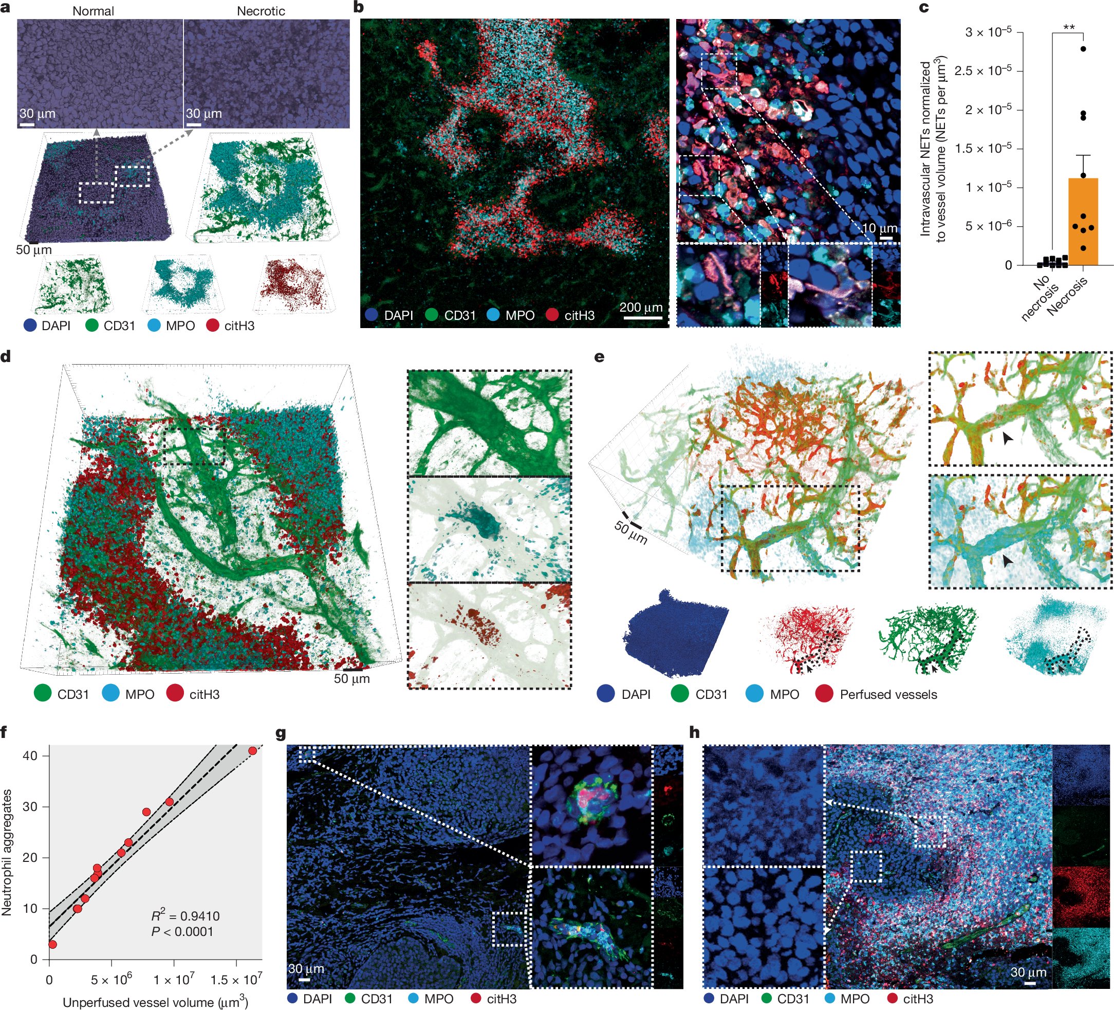 megeblad's tweet card. Nature - Neutrophils actively induce tumour necrosis, driving vascular occlusion, pleomorphic necrosis and metastasis.