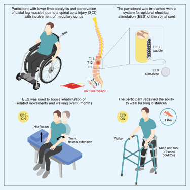 MedCellPress's tweet card. Albano et al. show how epidural electrical stimulation can be used even in spinal cord injury patient medullary cone involvement to enhance lower limb motor functions. They also demonstrate that...