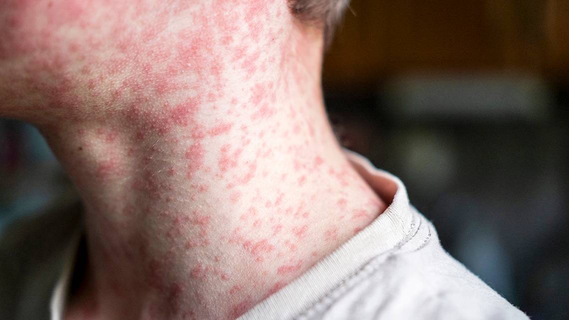 ValeskiLucy's tweet card. The first measles case in South Carolina since Sept. 2024 was confirmed. Here are the symptoms residents should be aware of.