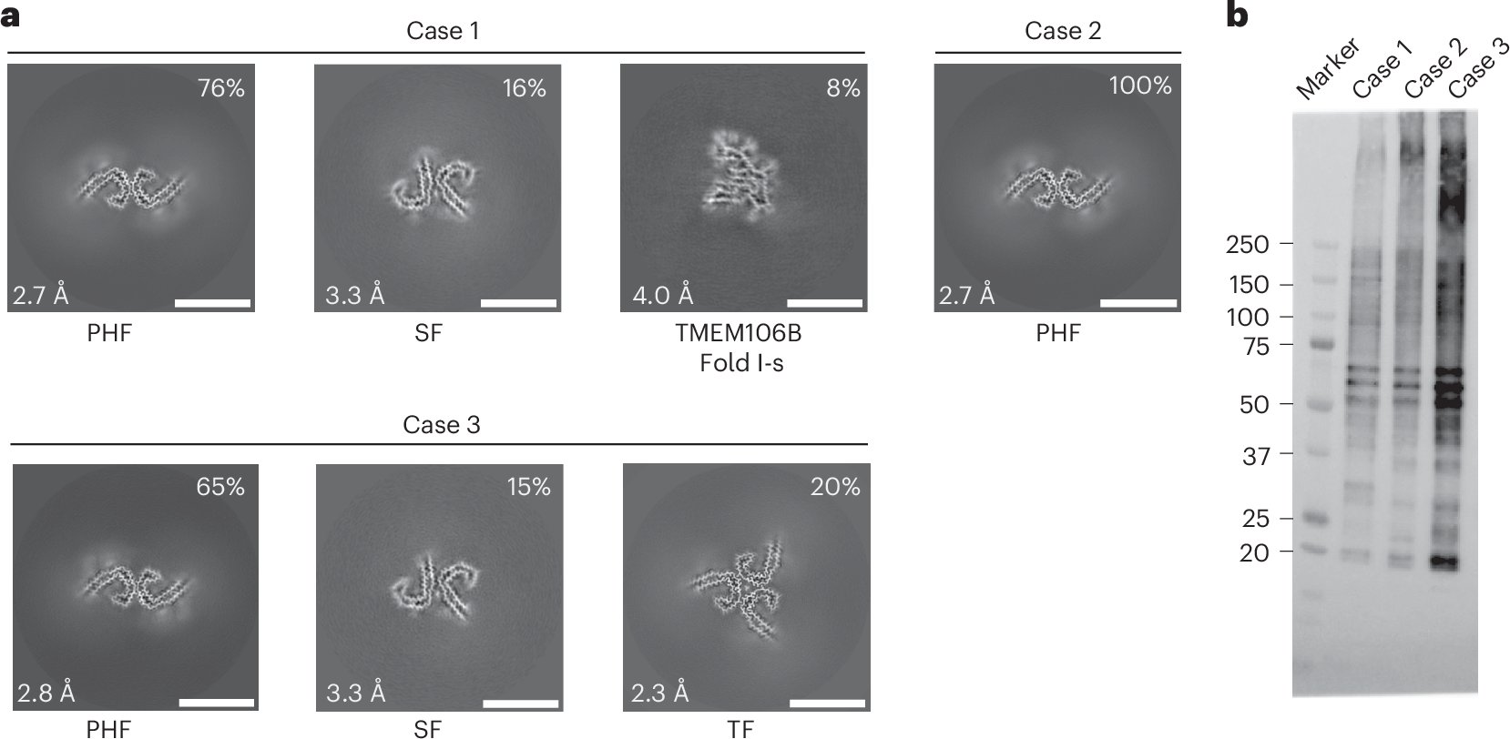 NeuropathClinic's tweet card. Nature Structural & Molecular Biology - Qi et al. used cryo-electron microscopy to determine the structures of tau filaments from the brains of individuals with MAPT mutants V337M and R406W,...