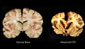 StopCTE's tweet card. Contact sports are becoming increasingly popular in Africa, raising concern about the risk of chronic traumatic encephalopathy (CTE). This report highlights the urgent need for awareness, education,...