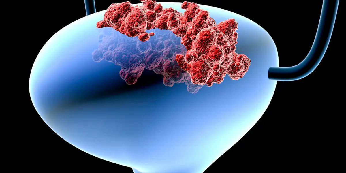 OncNewsCentral's tweet card. Translating biomarker discoveries into real-world tools remains a challenge in bladder cancer, especially in terms of tailoring treatment for metastatic disease.
